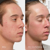 Epicutis Hydrobiome Serum
