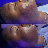 Single New Client Acne Program Consult + Treatment